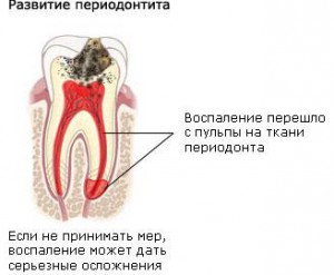 Периодонтит у детей