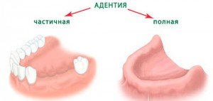 Адентия в стоматологии