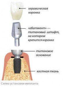 Современная дентальная имплантация зубов