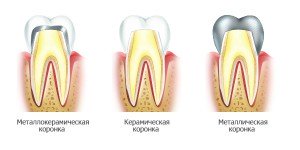 Коронки на зубы и цена