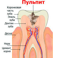 Пульпит у детей