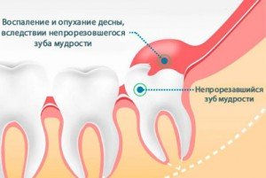 Зубы мудрости у человека