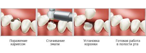 Как ставят коронку на зуб?