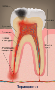 Хронические периодонтит