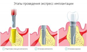 Экспресс метод имплантации зуба