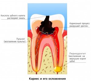 Причины кариеса зубов