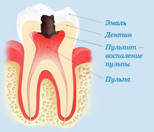 Пульпит зуба. Что это?