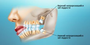 А нужно ли удалять зубы мудрости?